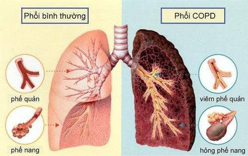 Bệnh phổi tắc nghẽn mạn tính có chữa khỏi được không?